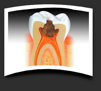 imagine cu cariile dentare